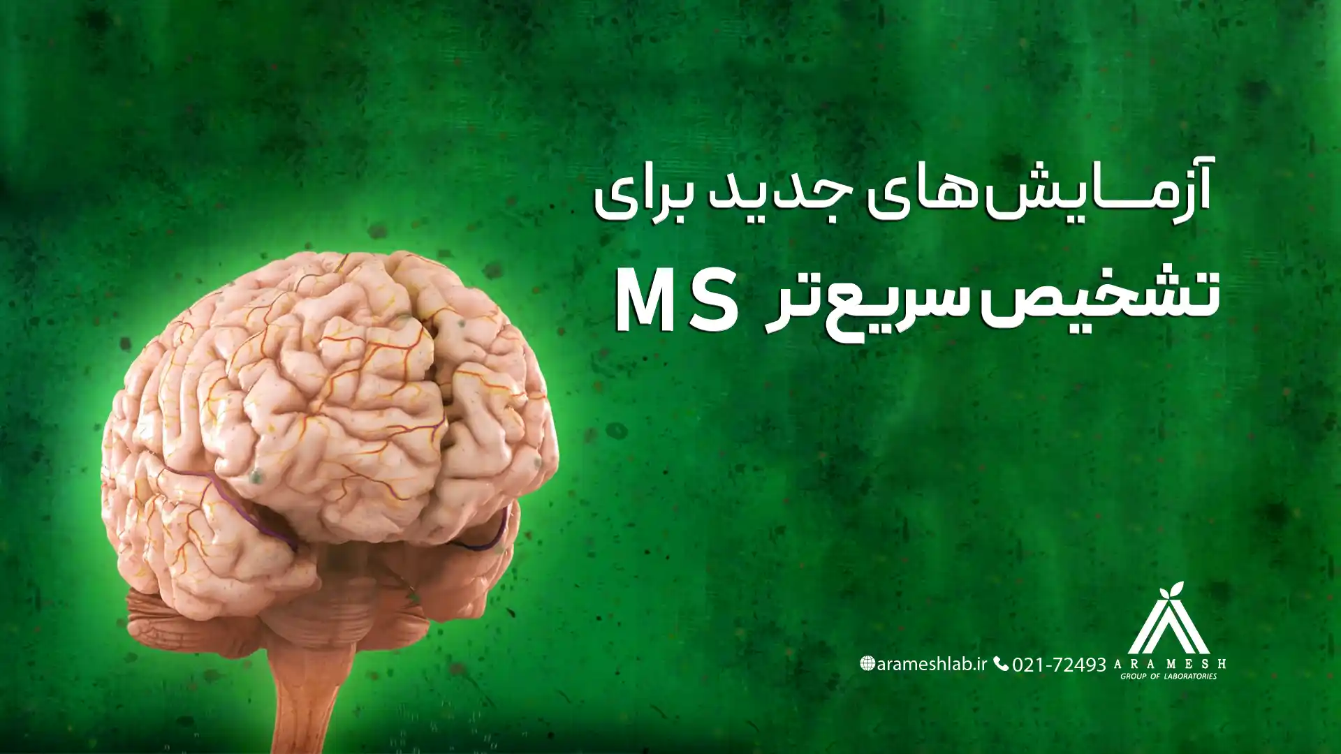 آزمایش های جدید ام اس MS-تشخیص سریع ام اس- آژمایشگاه شبانه روزی آرامش